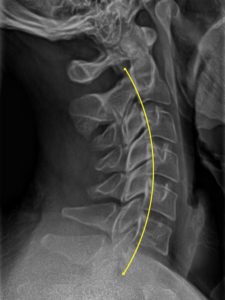 Case 30 - After iTrac Correction