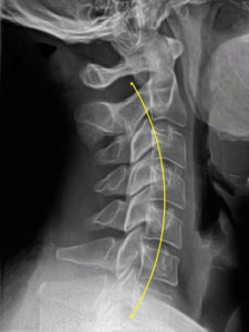 Case 30 - Before iTrac Correction